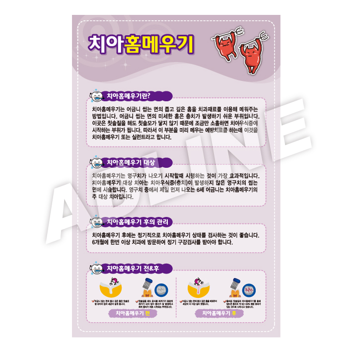 치아홈메우기